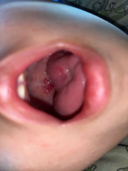 至急回答お願いします。 5歳の息子が口の中の痒みを訴えています。 喉とゆうか、喉の付近が赤くなっています。 熱はありません。その他、体に症状ありません。 病院に行きましたが、ヤブ医者っぽい所で ...