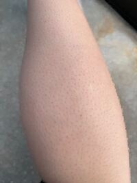 閲覧注意 脚の毛穴の赤みや黒ずみがやばいです これでもサ Yahoo 知恵袋