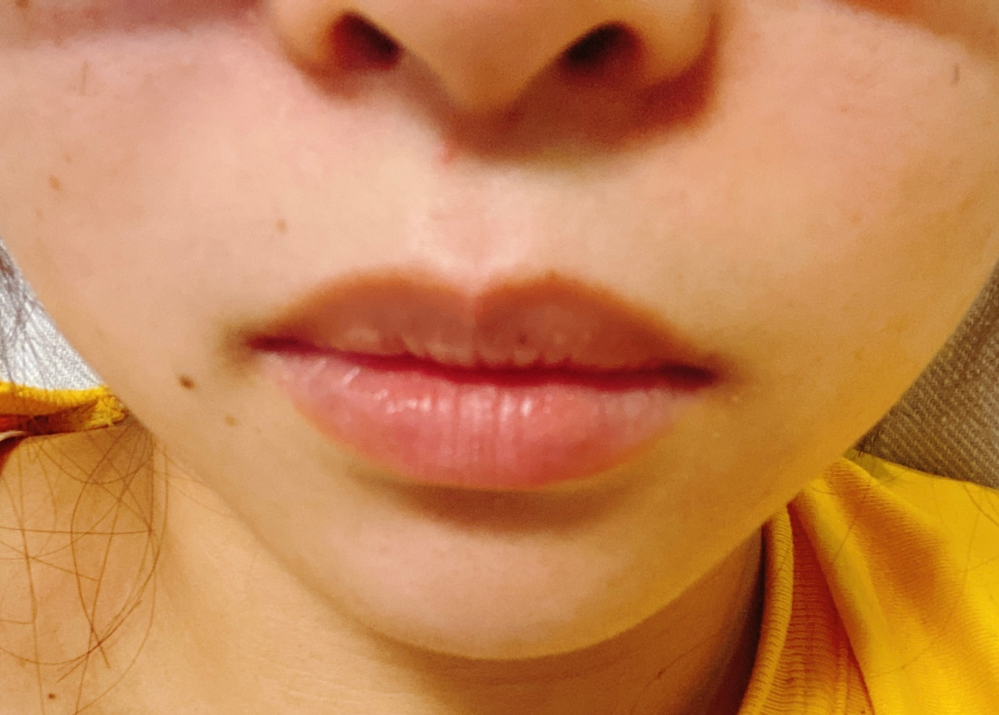 人中が浅いとあまりよくない だらしが無いと聞き自身をチェックした Yahoo 知恵袋