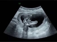 妊娠中15週です エコー写真で突起物が見え 男の子かも でもまだ Yahoo 知恵袋