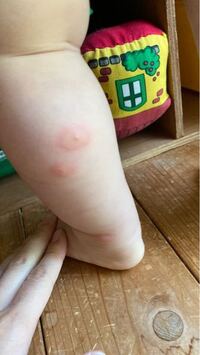 数日前 虫刺され程度の赤いポツッとしたものができていてあまりきに Yahoo 知恵袋