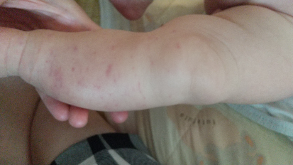 3ヵ月赤ちゃん内出血が多数 写真あり今朝7時にはなかったと思いますが 今赤 Yahoo 知恵袋