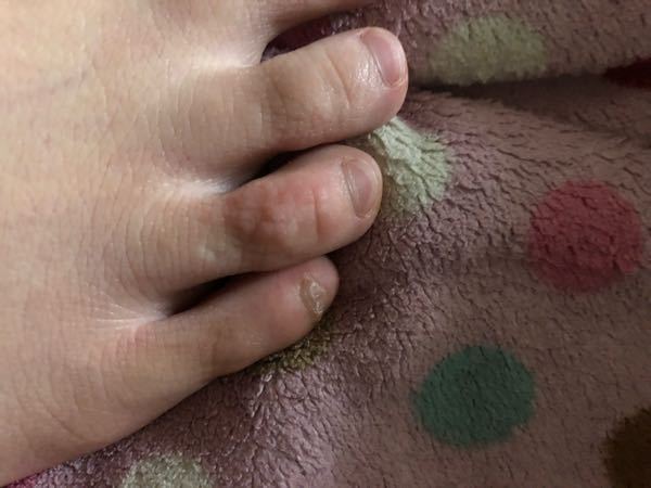 水虫 すべての質問 Yahoo 知恵袋