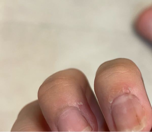 爪と指の隙間？(甘皮)みたいなところがぱっくりとしているのですがこれは大丈夫なのでしょうか…？ 左が普通の爪で右がぱっくりしてる爪です。 甘皮処理とかは特にしていません。