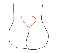 お尻の仙骨辺りがイラストの赤い部分のように逆三角形に膨らんでいます 痛みは Yahoo 知恵袋