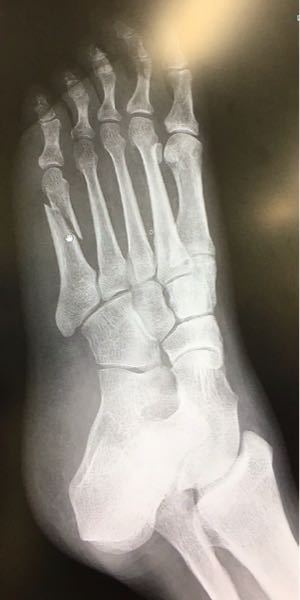 足の第五中足骨骨折をしました。 通称下駄骨折この骨折は歩いてもあまり痛くなく整形外科では保存療法のみで固定して様子を見るしか無いと言われましが、骨折なので接骨院では何が出来るのででしょうか。？あまり骨 折の説明もしてくれなかったのでレントゲンから見て全治までどのくらいかかるか教えて頂きたいです。