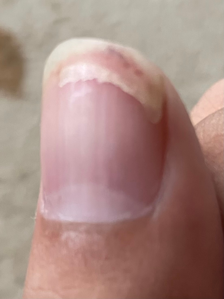 グロい写真ですみません。先日ボウリングで爪が割れてしまってピンク色の部分まで爪割れしたのですがこれは剥がした方が良いのでしょうか？