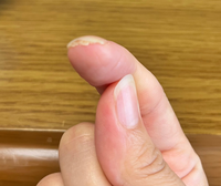 爪が伸びても伸びても、もう5年ほどこの状態です。
ひどい時もあり痛みがあることも。
一度皮膚科でわからないと言われました。
一体何なのでしょう。
二枚爪？角質？ 
