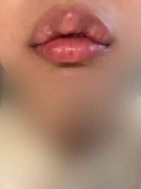 今日、唇のヒアルロン酸注射をしました。 1ccをM字リップになるようにお願いしたところ、
注入部分が白くしこりになっています。

これは失敗でしょうか…？