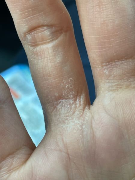 手の荒れについての質問です。 右手薬指の付け根がカサカサして皮がむけます。 痒みや痛みは無いのですが、カサカサが気になります。 どうしたら治るでしょうか？
