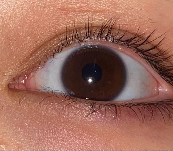 目の際にある白っぽいできもの これなんですか？ 痛くも痒くもない 頻繁にできます