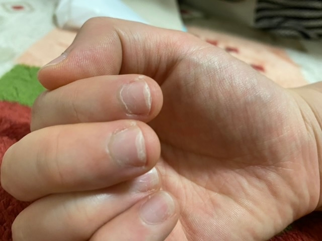 二枚爪で悩んでいます。 元から爪が柔らかく、すぐに欠けたりしていました。 1年ほど前に二枚爪になってから、ギリギリまで爪を切ってもそれより深く二枚爪になっています。 伸ばしても切れる範囲の爪より...