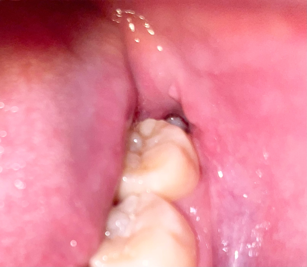 ※口の中の写真あります。 約1ヶ月前の横向き親知らず抜歯後の白いものについて 私は約1ヶ月前に左の横向き親知らずを切開して抜いたのですが、抜いてから2週間くらい経ってから傷口の食べかす予防に食後...