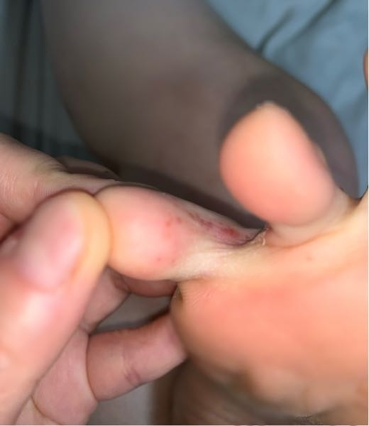 これは水虫ですか？ 痛くも痒くもありません。 見ずらいですが指の間の皮が剥けたりしてます