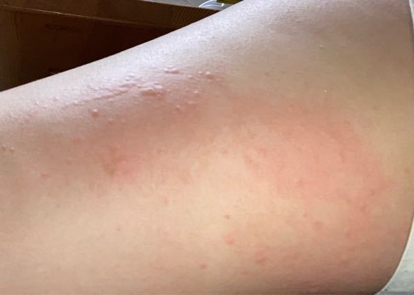 これは蕁麻疹で合ってますか？今までずっと蕁麻疹だとも思っていたけど怖い病気とかだったら嫌だなと思い、わかる方教えてください。蚊に刺されのように見える部分もありますとっても痒いです。