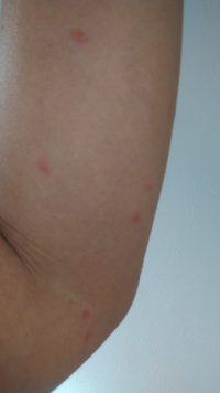 畳の部屋で寝ていたら 左腕だけ写真の赤い斑点ができていました これはダニで Yahoo 知恵袋