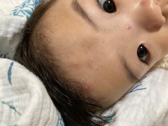 皮膚の病気 アトピー 解決済みの質問 Yahoo 知恵袋