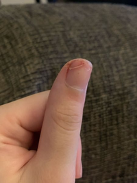 指と爪を包丁で切ってしまいました 亀裂が上の部分まで到達してない Yahoo 知恵袋