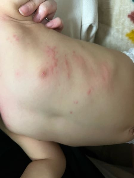 皮膚の病気 アトピー 解決済みの質問 Yahoo 知恵袋