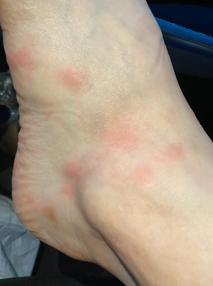 皮膚の病気 アトピー 解決済みの質問 Yahoo 知恵袋