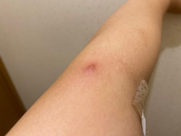 （閲覧注意）粉瘤らしきものの写真があります。 これって粉瘤ですか…？ それとも何か違うできものですかね…？ 触る（掴む？）と少しこりこりしている感じがあります。 粉瘤というものを知らずに今日...