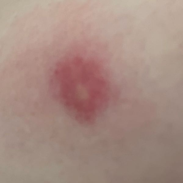 これは蚊に刺された跡ですか？ 虫刺されではあると思うのですが、動かすたびに痛痒く、大きく腫れて真ん中の赤みだけ消えてきました。
