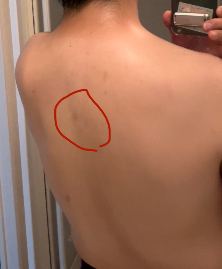 肩甲骨ら辺が肉体労働をすると痛みます。 写真のように本日背中に茶色いあざのようなものができました。 これは何かの病気でしょうか。