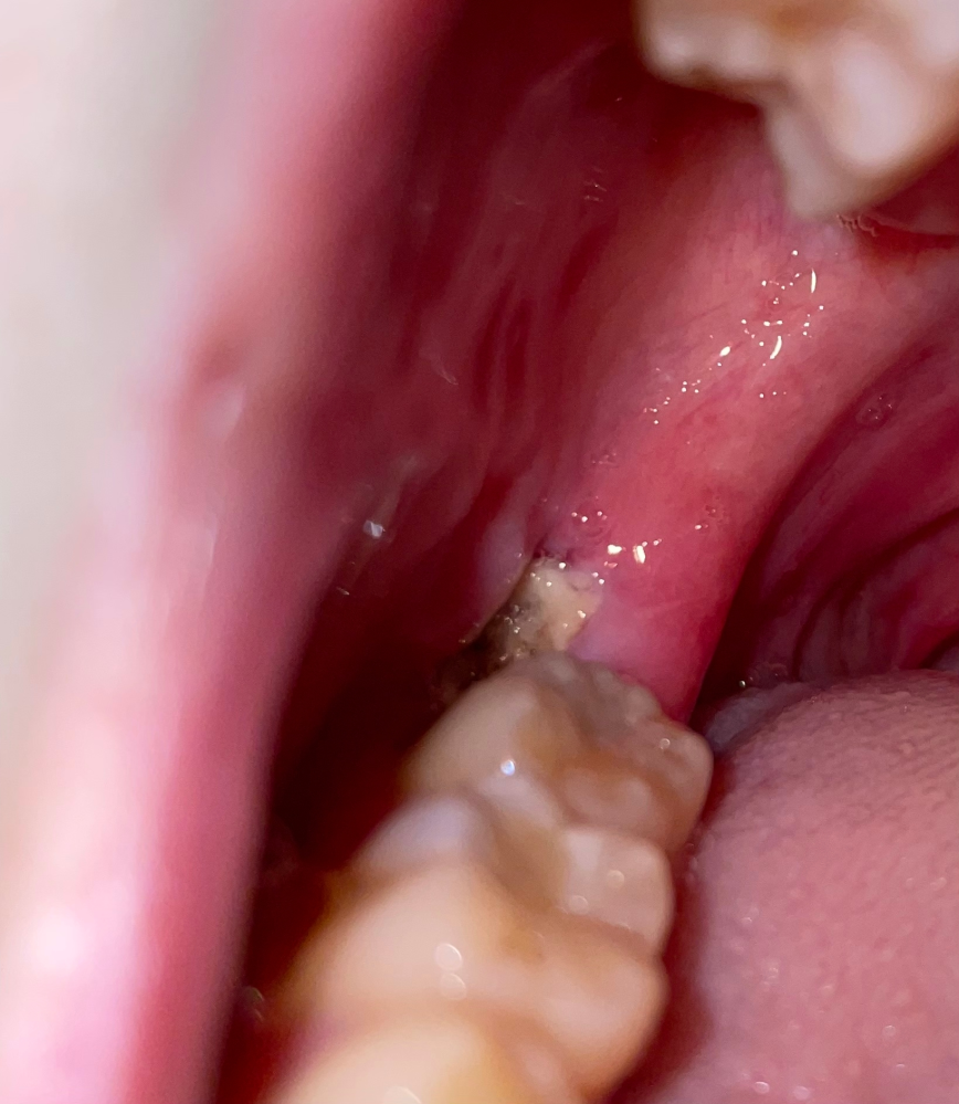閲覧注意 親知らず抜歯後白い塊ちょうど1週間前に右上下の親知らずを抜歯し Yahoo 知恵袋