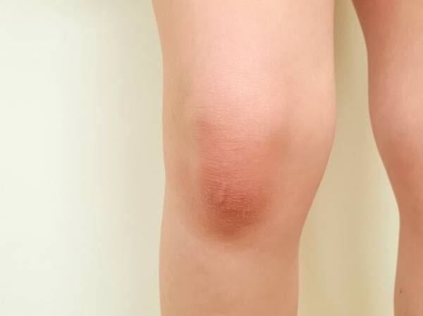 膝と脛を繋いでる部分？を押すと片方は痛くないのにもう片方を押すと、逆関節みたいになり、痛いです。画像で言うこの黒ずんでるところです。何が原因なのでしょうか？調べたりしても出てこないのでわからないです。