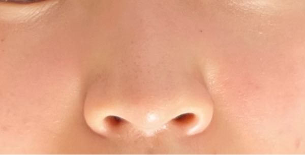 鼻の画像あり。高校生の女です。自分の鼻がとてもコンプレックスです。鼻の穴が正面から見たときに見えるのと、鼻がでかいのがとても気になってます。どうすれば鼻の穴が下向くようになるでしょうか。 この鼻についてコメントお願いします。