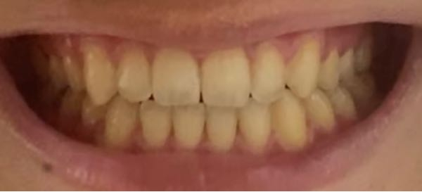 矯正 料金 画像あり この歯並びを矯正しようとする場合、いくらくらいかかるでしょうか。