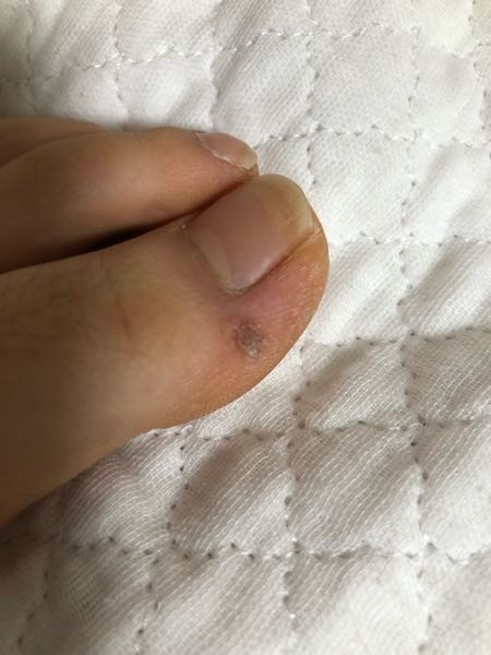 足の親指にこのようなものがずっとあります。結構固めですが、取ろうとすると痛いです。治し方はありますか？