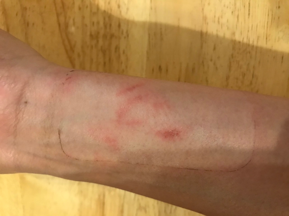 オクラの収穫をしていたら何かに刺されました。 オクラを収穫するので腕のカバーはしてます。 最初はチクチクして蚊に刺された感じに膨れて かなり痛かったです。 痒みはいっさいないです。 痛かったので絆創膏貼ったので触れてないです。 よろしくおねがい致します。