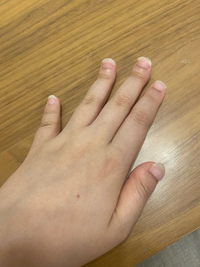 この指、全部、マムシ指なんですかね？？最近爪の形に悩んでいて、この形なのでネイルもできないし、コンプレックスです。これは治るのでしょうか。※爪長くてごめんなさい。 