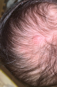 生後5ヶ月の子供がいるのですが 今後頭部を見たら 蚊に刺されたよ Yahoo 知恵袋