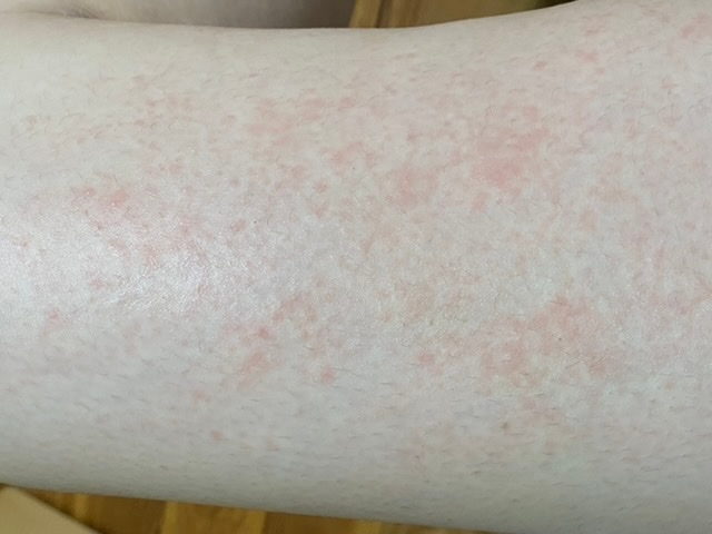 皮膚の病気 アトピー すべての質問 Yahoo 知恵袋