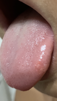 未熟児網膜症 網膜剥離に詳しい方に教えて頂きたいです 早産で子供が660gで Yahoo 知恵袋