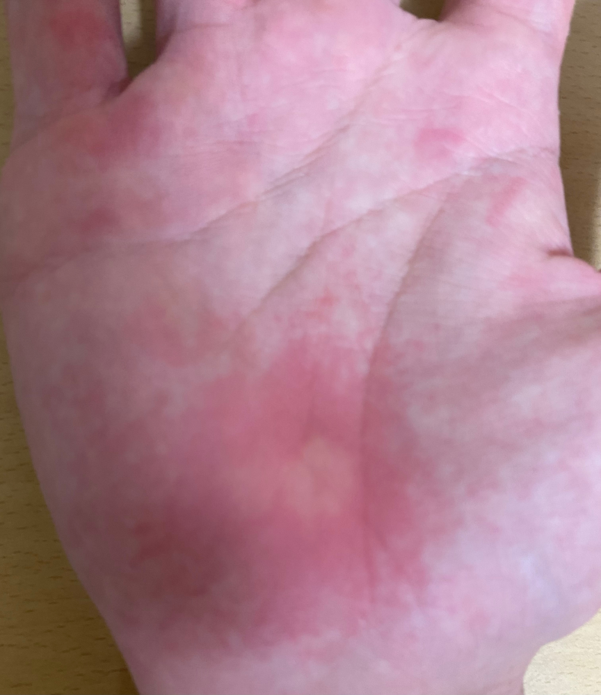 皮膚の病気 アトピー すべての質問 Yahoo 知恵袋