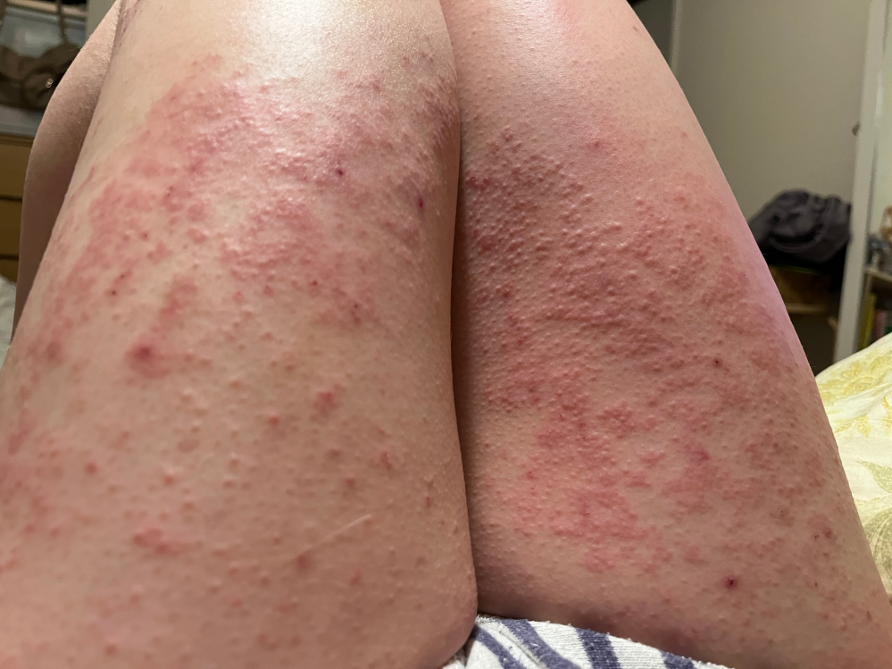 性病 性感染症 解決済みの質問 Yahoo 知恵袋