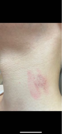 これってキスマークだと思いますか 彼氏の首についていました 本人は絶対に違 Yahoo 知恵袋