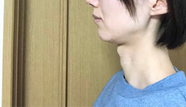 喉仏しこり画像 _ 喉仏 しこり 女性 : 頭頸部がんについて – SZHSO