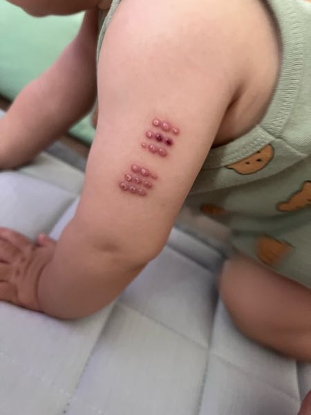 BCGの予防接種の跡についての質問です。 現在8ヶ月の子どもです。 6/6にBCGの予防接種をうけました。 1ヶ月後には膿をもった状態になり腫れていましたが この頃ではほとんどかさぶたのようになってきていました。 先ほど気づくと、写真のように一部赤黒くなっている箇所を発見しました。 昨日のお風呂の時にはこのようになっていなかったように思います。 このまま放置していて大丈夫でしょうか？ また、今日の午前中ベビースイミングの体験に行ったのですがなにか関係あるのでしょうか？ どなたかわかる方や経験のある方ご回答よろしくお願いします！