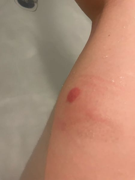 至急！！！！！ 虫に刺された覚えないのですがすっごく痒いです(´；ω；｀) これ蚊とかだといいんですが何か分かりますか？(´；ω；｀)(´；ω；｀)(´；ω；｀)かゆい！！！！ 蚊にしてはデカすぎる！！！ かゆい！！！！！！うわああああああああ