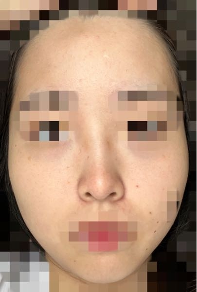 23歳女です。自分に合った化粧水や洗顔料などがわからず今まで一切スキンケアをしていませんでした。 しかしこのままではいけないと思い、スキンケアをしたいのですが、一切知識がなく何を手に取ったらいいのかわかりません。 そういった場合はどこにいけばいいのでしょうか？ 美容皮膚科や美容クリニックでそういった相談はできるのでしょうか？調べたところ、自分の治したいところがわかってる方は施術はできるが、スキンケアの相談などの項目は見つからなくて....。 また、気になる点としては、鼻の毛穴(いちご鼻)、おでこのニキビ、しみ、全体的な艶やはりです。 ・自分に合ったスキンケアを知りたい ・現在の肌の問題点を知りたい ・問題点を解決する施術方法を知りたい これはどこにいったら解決しますか？教えていただきたいです。 肌の画像も載せますので何か改善点等ありましたら教えていただきたいです。