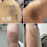 彼氏との喧嘩について質問です。

先日彼氏と喧嘩した際、話し合いをせずスマホを触っていたので取り上げようとした際、左二の腕を強く掴まれました。 その後、ベッドの上から持ち上げられ身体を床に叩きつけられて、写真のような痣ができました。翌朝には仲直りしたのですが、彼氏との喧嘩でこのような痣ができるほど掴まれたりするのはふつうなのでしょうか？