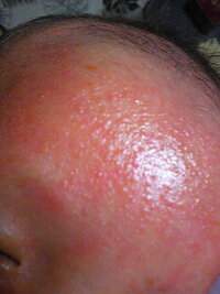 乳児湿疹について生後１ヶ月なんですが生後２週間頃から湿疹ができは Yahoo 知恵袋