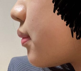 ❗️❗️至急❗️❗️ これって口ゴボの部類ですかね？！！！ 見苦しい写真ですみません、、