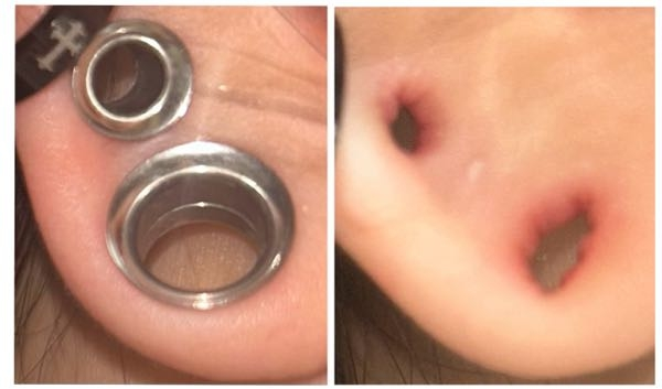 ピアス 拡張についてなのですが、写真の大きい方が00g、小さい方が2gです。 00を12mm、2を0にしたいのですが、穴が繋がっちゃいますかね？ きったないホールですみません; ; 分かる方いたら教えて欲しいです> <