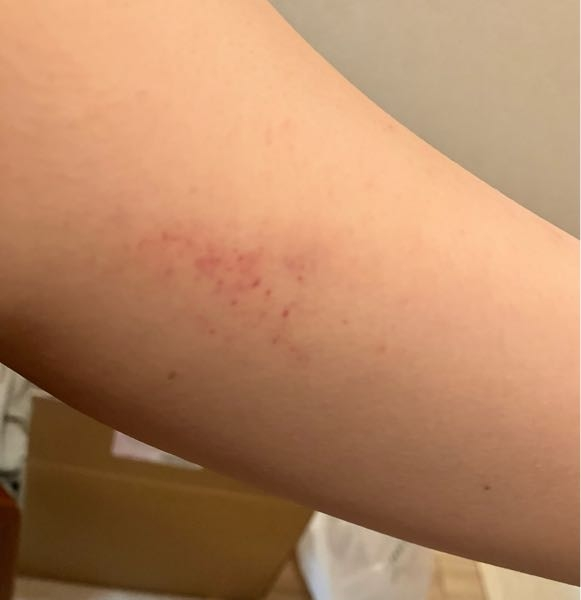 写真は二の腕です。 二の腕の内側に赤い斑点？ブツブツ？が出来てました。立体感はなく、表面はサラサラしてます。痒みもありません。 これが何か詳しい方教えていただきたいです。