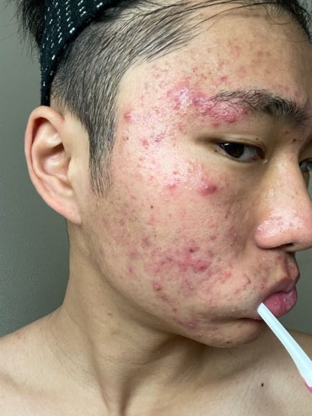 ニキビで悩んでます。思春期ニキビは保湿が逆に良くないと先生に言われたので現在は洗顔とエピデュオを使ってます。保湿をやめてから5日たちますが赤いニキビが全然消える気配がありません。 大学入るまでに...